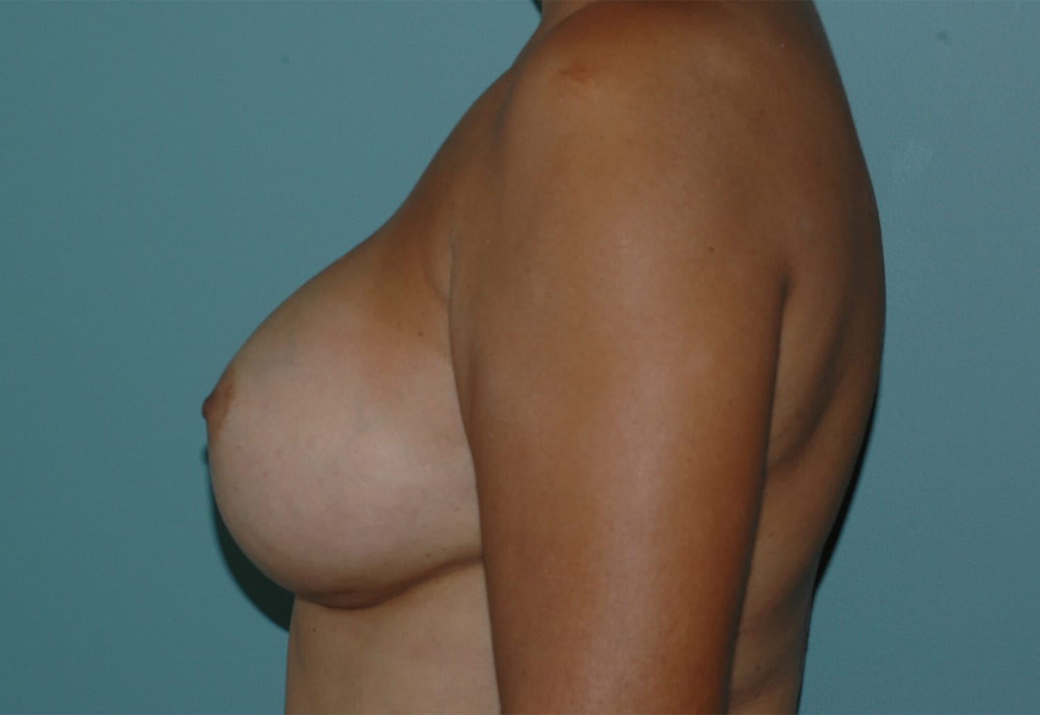 After Image: Breast Augmentation - left-side